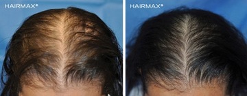 Лазерная расческа Hairmax Ultima12 для домашнего использования, для роста волос FDA