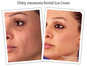 Revitol Scar Cream от старых шрамов и растяжек ШАНС!