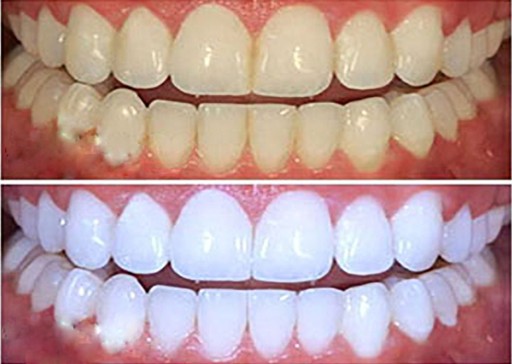 отбеливание зубов boost отзывы